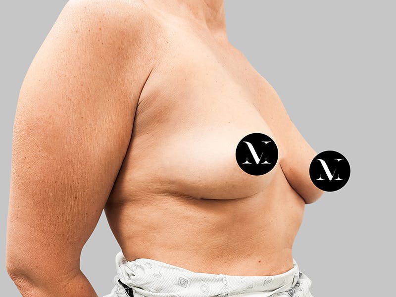 Breast Augmentation Before & After Gallery - Patient 187989836 - Image 9