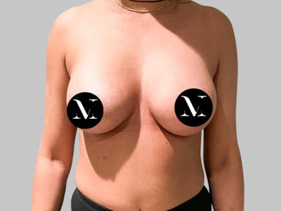 Breast Augmentation Before & After Gallery - Patient 187989838 - Image 2