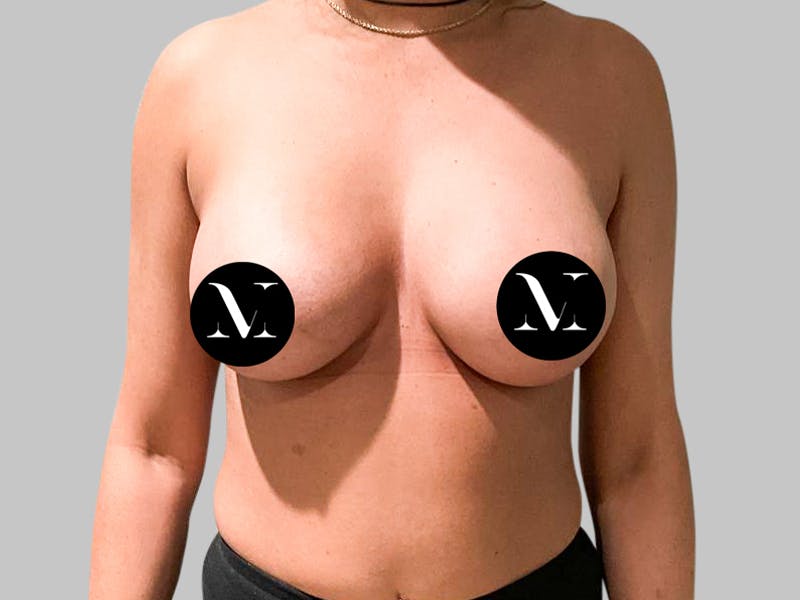 Breast Augmentation Before & After Gallery - Patient 187989838 - Image 2
