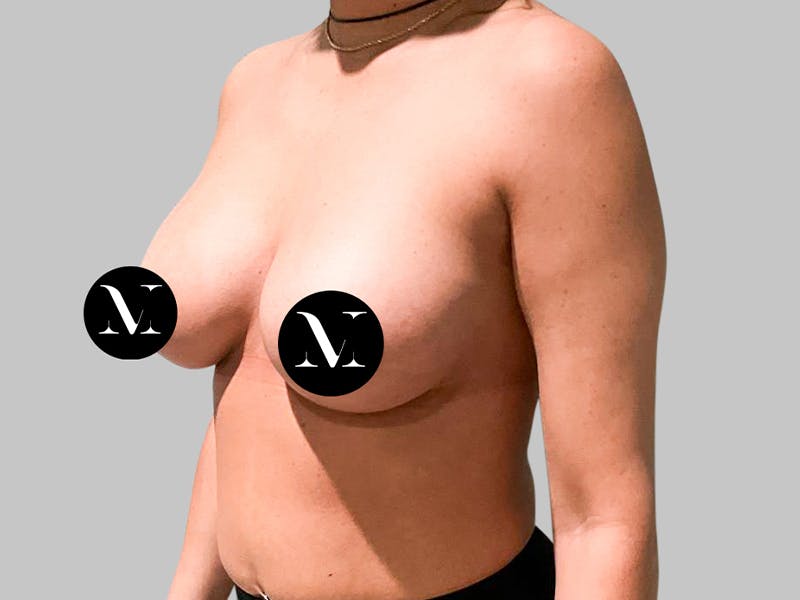 Breast Augmentation Before & After Gallery - Patient 187989838 - Image 4