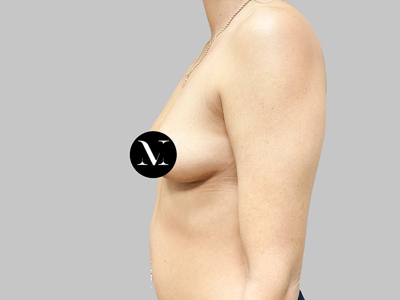 Breast Augmentation Before & After Gallery - Patient 187989838 - Image 5