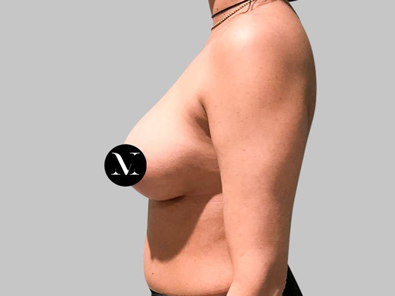 Breast Augmentation Before & After Gallery - Patient 187989838 - Image 6