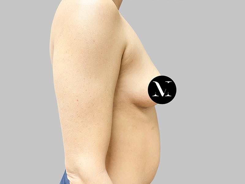 Breast Augmentation Before & After Gallery - Patient 187989838 - Image 7