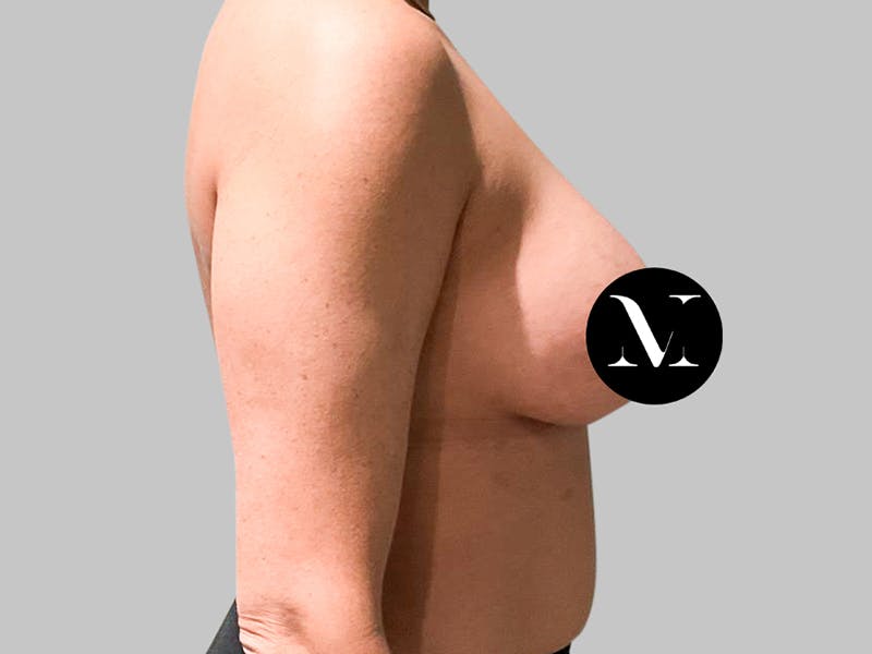 Breast Augmentation Before & After Gallery - Patient 187989838 - Image 8