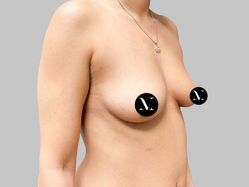 Breast Augmentation Before & After Gallery - Patient 187989838 - Image 9