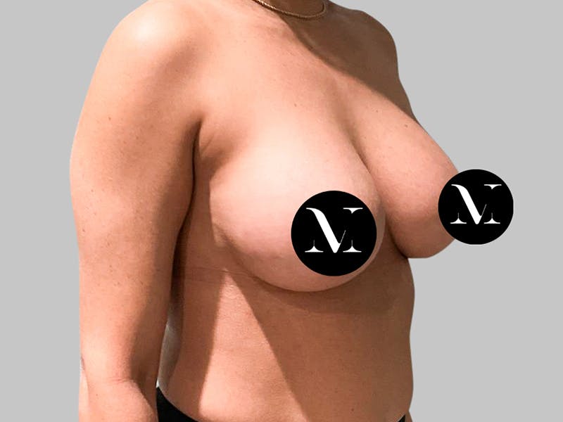 Breast Augmentation Before & After Gallery - Patient 187989838 - Image 10