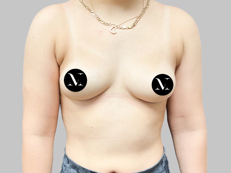 Breast Augmentation Before & After Gallery - Patient 187989839 - Image 1