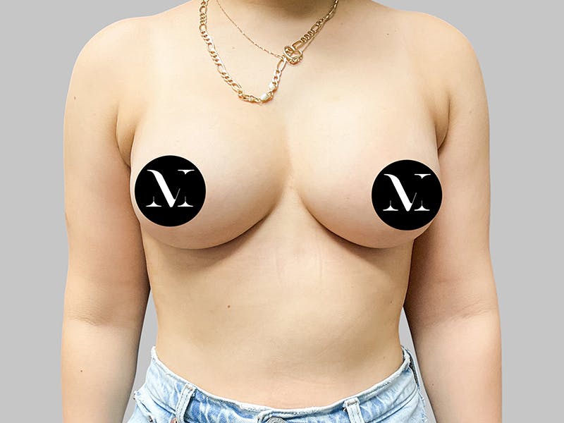 Breast Augmentation Before & After Gallery - Patient 187989839 - Image 2