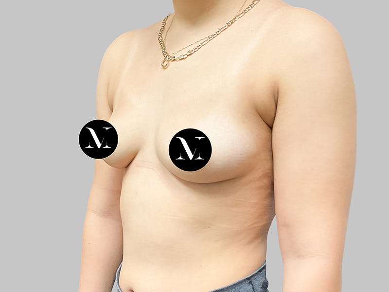 Breast Augmentation Before & After Gallery - Patient 187989839 - Image 3