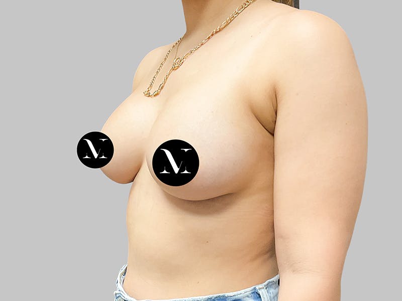 Breast Augmentation Before & After Gallery - Patient 187989839 - Image 4