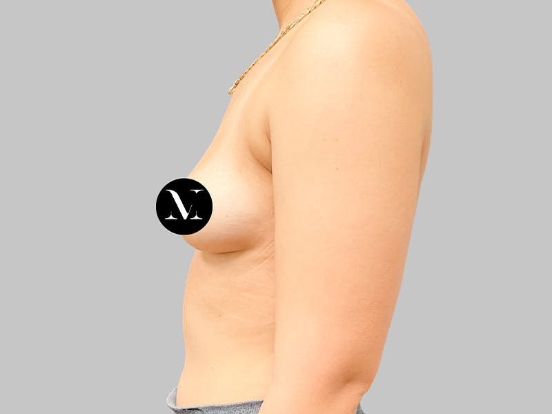 Breast Augmentation Before & After Gallery - Patient 187989839 - Image 5