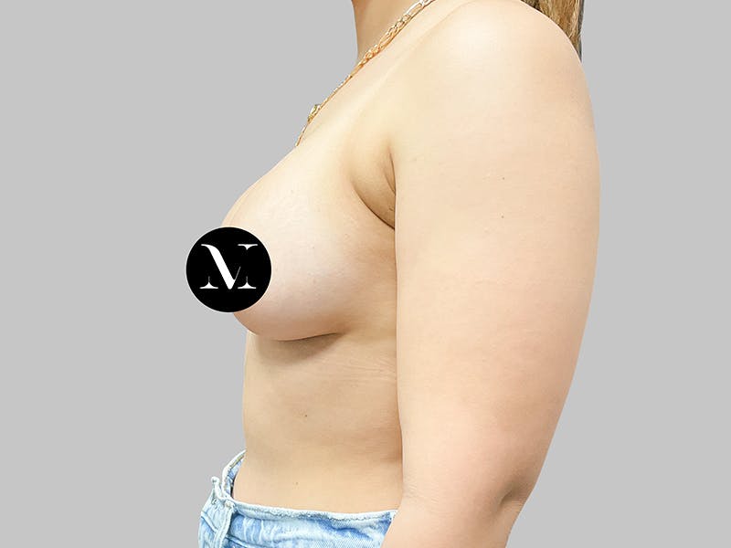 Breast Augmentation Before & After Gallery - Patient 187989839 - Image 6