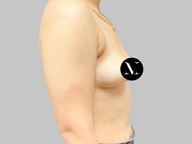 Breast Augmentation Before & After Gallery - Patient 187989839 - Image 7