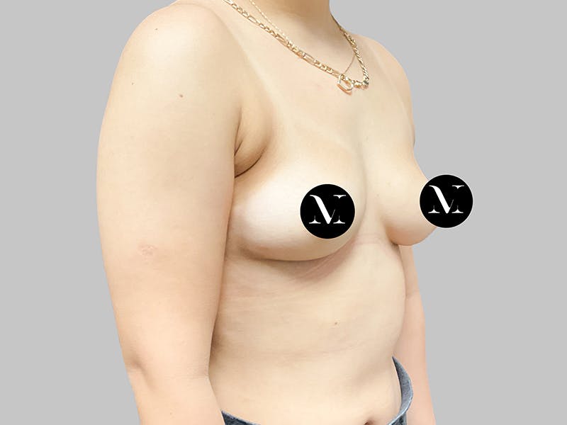 Breast Augmentation Before & After Gallery - Patient 187989839 - Image 9