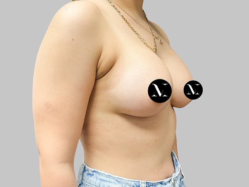 Breast Augmentation Before & After Gallery - Patient 187989839 - Image 10