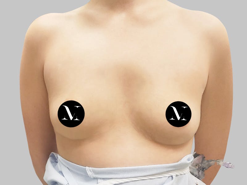 Breast Augmentation Before & After Gallery - Patient 187989840 - Image 1