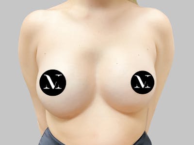 Breast Augmentation Before & After Gallery - Patient 187989840 - Image 2