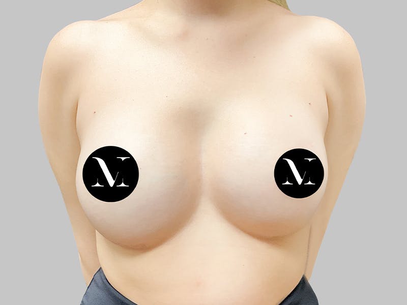 Breast Augmentation Before & After Gallery - Patient 187989840 - Image 2