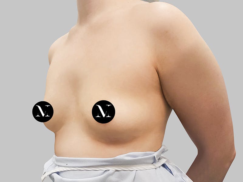 Breast Augmentation Before & After Gallery - Patient 187989840 - Image 3