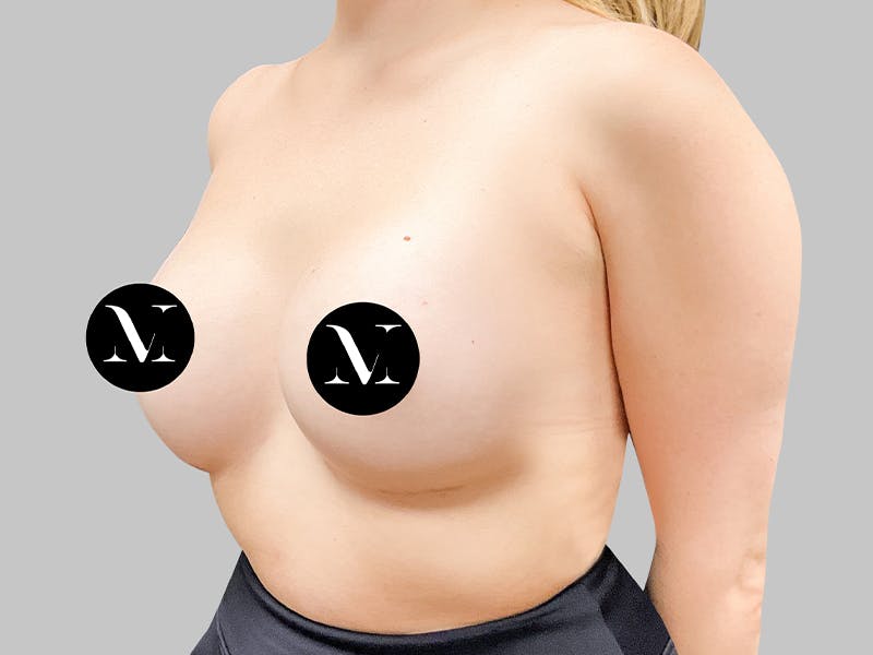 Breast Augmentation Before & After Gallery - Patient 187989840 - Image 4