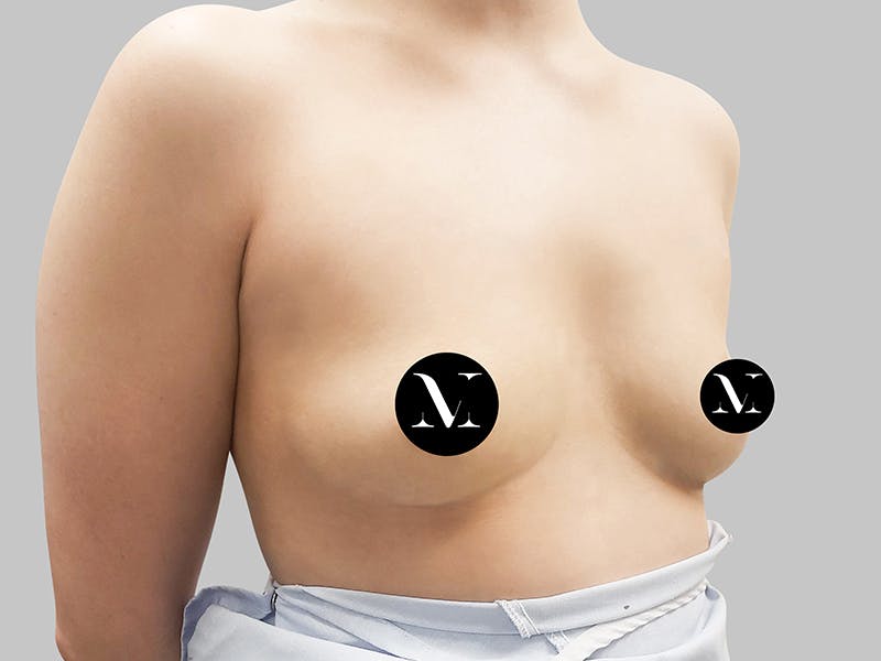 Breast Augmentation Before & After Gallery - Patient 187989840 - Image 5