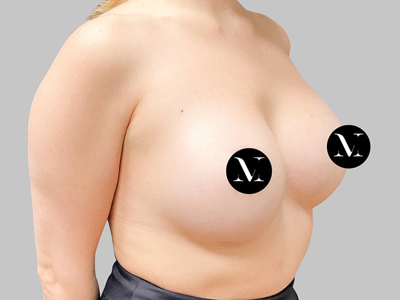 Breast Augmentation Before & After Gallery - Patient 187989840 - Image 6