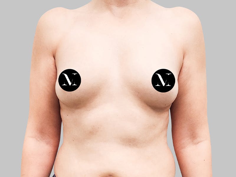 Breast Augmentation Before & After Gallery - Patient 187990824 - Image 1