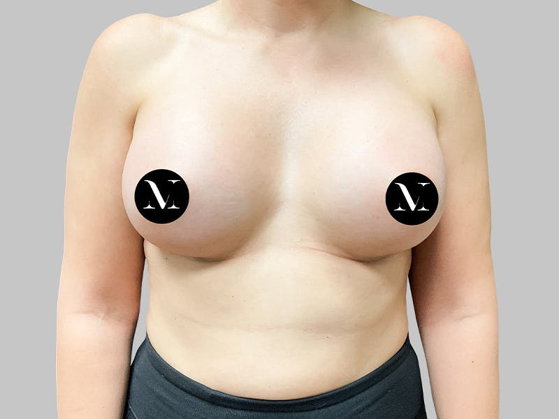 Breast Augmentation Before & After Gallery - Patient 187990824 - Image 2