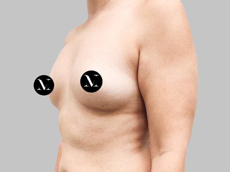 Breast Augmentation Before & After Gallery - Patient 187990824 - Image 3
