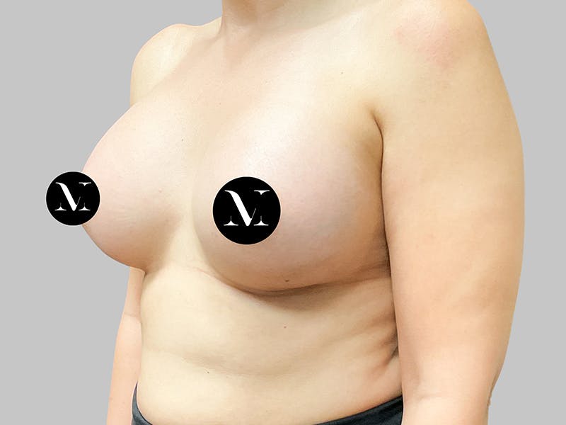 Breast Augmentation Before & After Gallery - Patient 187990824 - Image 4