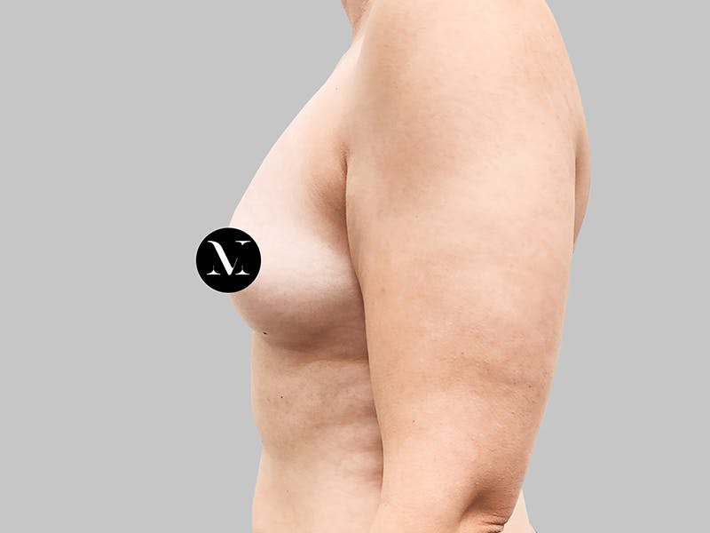 Breast Augmentation Before & After Gallery - Patient 187990824 - Image 5