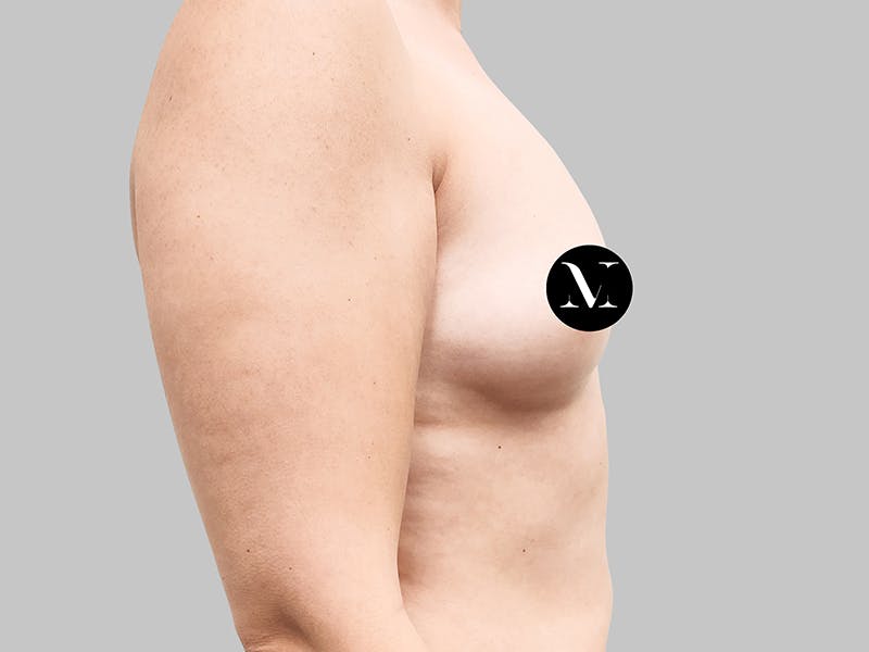 Breast Augmentation Before & After Gallery - Patient 187990824 - Image 7