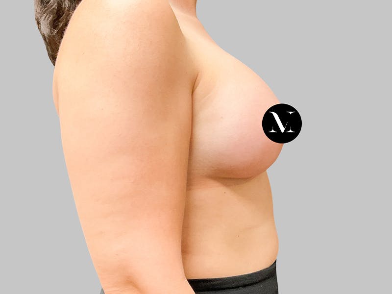 Breast Augmentation Before & After Gallery - Patient 187990824 - Image 8