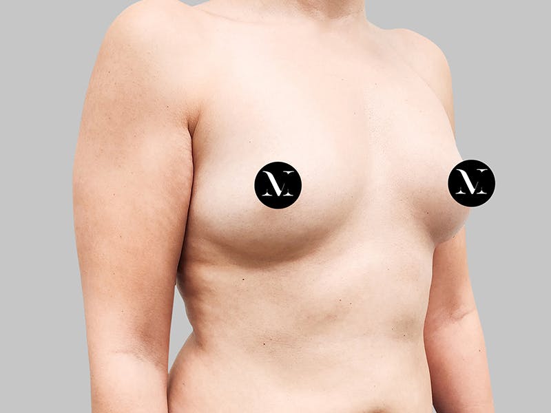 Breast Augmentation Before & After Gallery - Patient 187990824 - Image 9