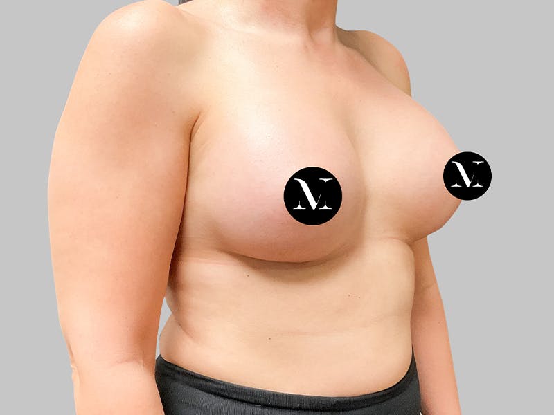 Breast Augmentation Before & After Gallery - Patient 187990824 - Image 10