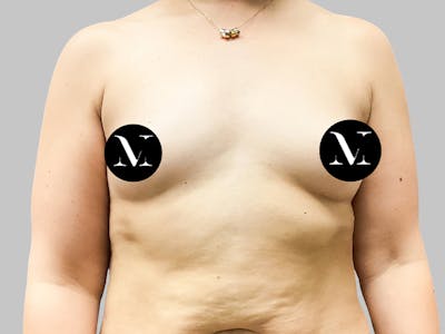 Breast Augmentation Before & After Gallery - Patient 189383388 - Image 1