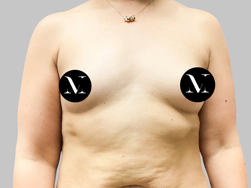 Breast Augmentation Before & After Gallery - Patient 189383388 - Image 1