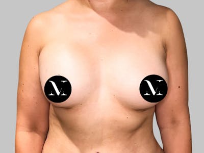Breast Augmentation Before & After Gallery - Patient 189383388 - Image 2