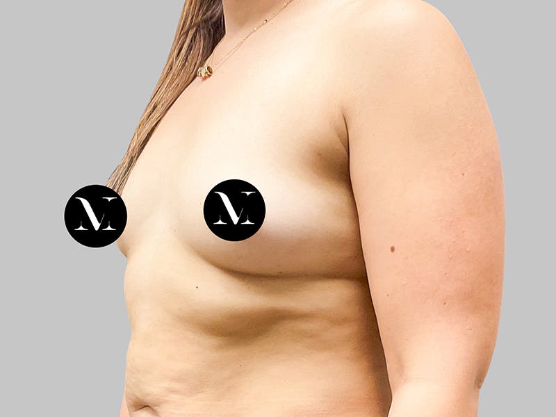 Breast Augmentation Before & After Gallery - Patient 189383388 - Image 3