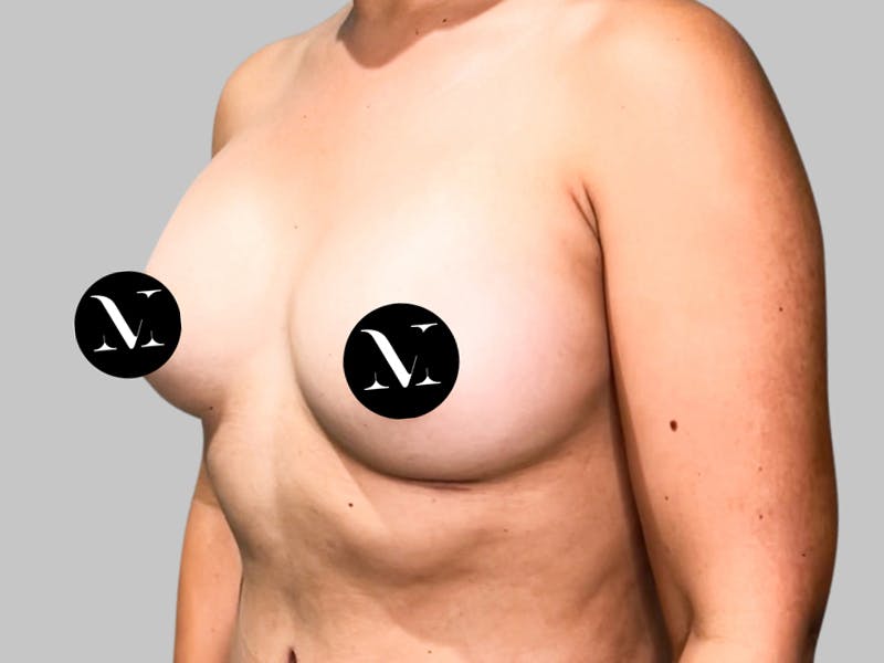 Breast Augmentation Before & After Gallery - Patient 189383388 - Image 4