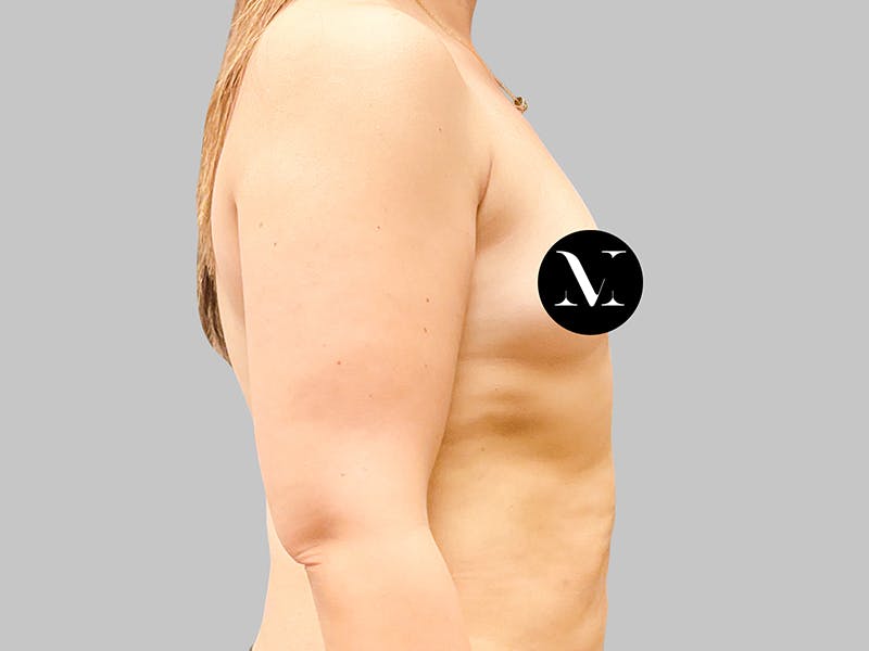Breast Augmentation Before & After Gallery - Patient 189383388 - Image 5
