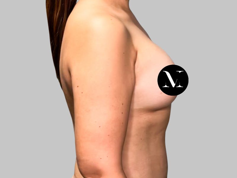 Breast Augmentation Before & After Gallery - Patient 189383388 - Image 6