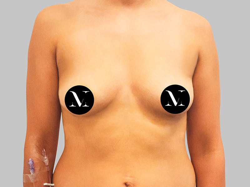 Breast Augmentation Before & After Gallery - Patient 381315 - Image 1