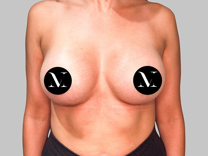 Breast Augmentation Before & After Gallery - Patient 381315 - Image 2
