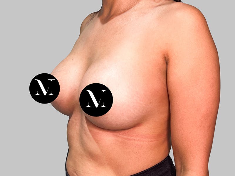 Breast Augmentation Before & After Gallery - Patient 381315 - Image 4