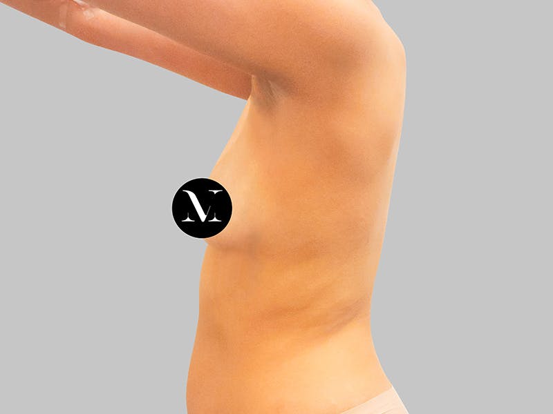 Breast Augmentation Before & After Gallery - Patient 381315 - Image 5