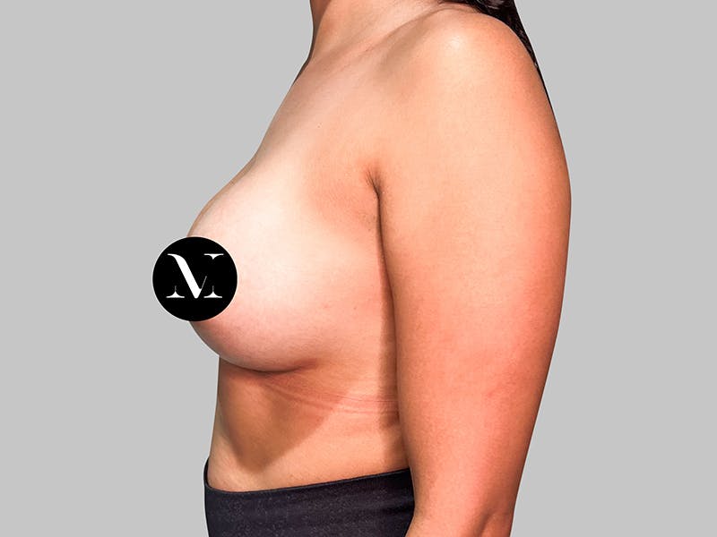 Breast Augmentation Before & After Gallery - Patient 381315 - Image 6