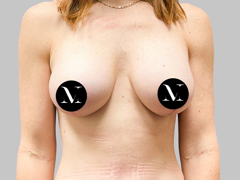 Breast Augmentation-Mastopexy Before & After Gallery - Patient 367783 - Image 2
