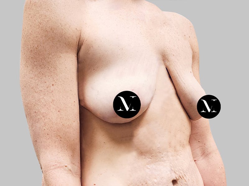 Breast Augmentation-Mastopexy Before & After Gallery - Patient 367783 - Image 3