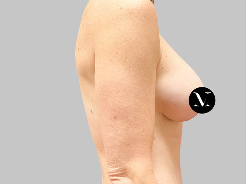 Breast Augmentation-Mastopexy Before & After Gallery - Patient 367783 - Image 6